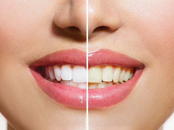 Patient’s smile before and after teeth whitening in Brookfield
