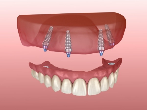 Animated smile during all on four dental implants placement