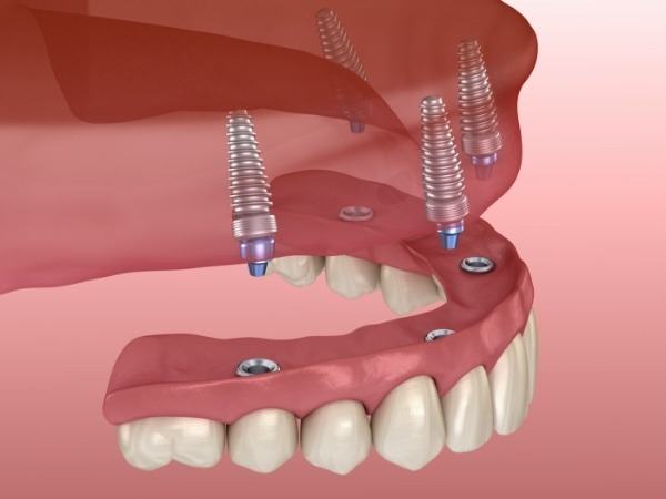 Animated smile during all on four dental implant placement