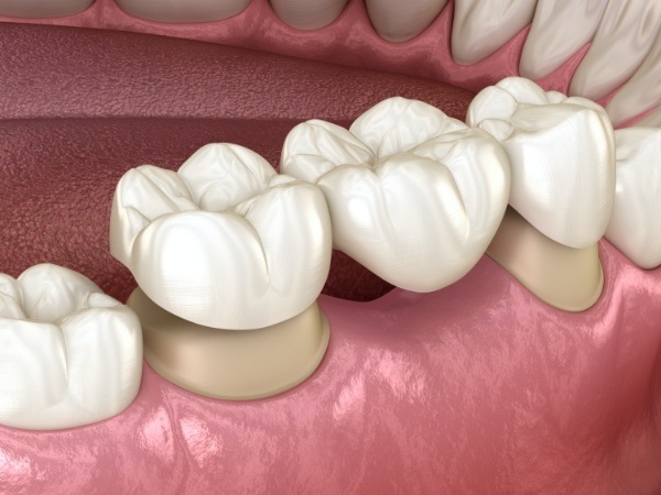 Animated smile during dental crown supported fixed bridge placement