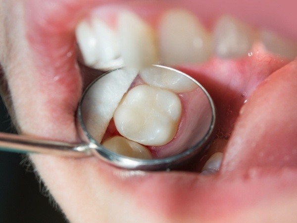 Closeup of flawless smile after tooth colored filling restoration