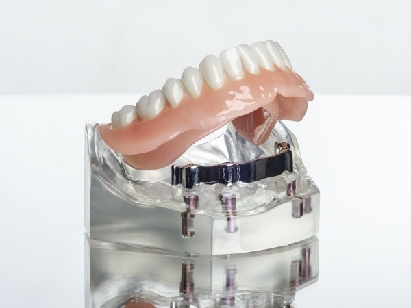 Model of a smile with implant denture in Brookfield