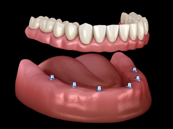 Animated smile during implant denture placement