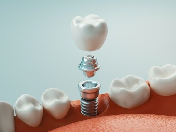 Animated smile during dental implant supported dental crown placement