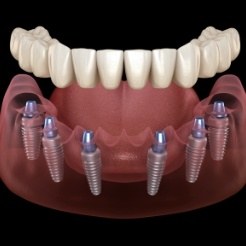 Animated smile during dental implant supported denture placement