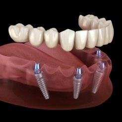Animated smile during all on four dental implant denture placement