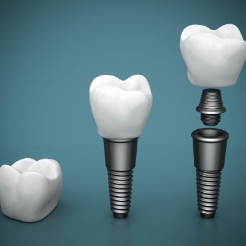 Animated parts of the dental implant replacement tooth