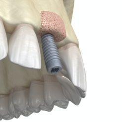 Animated smile showing dental implant osseointegration and abutment placement