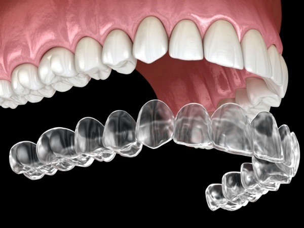 Animated smile during Invisalign clear braces tray placement