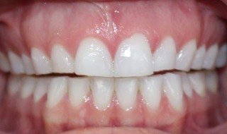 smile gallery before/after photo