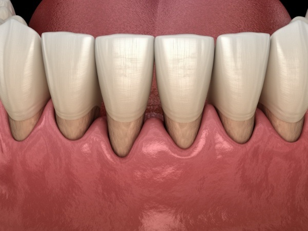 Animated smile with receding gums before gum disease treatment