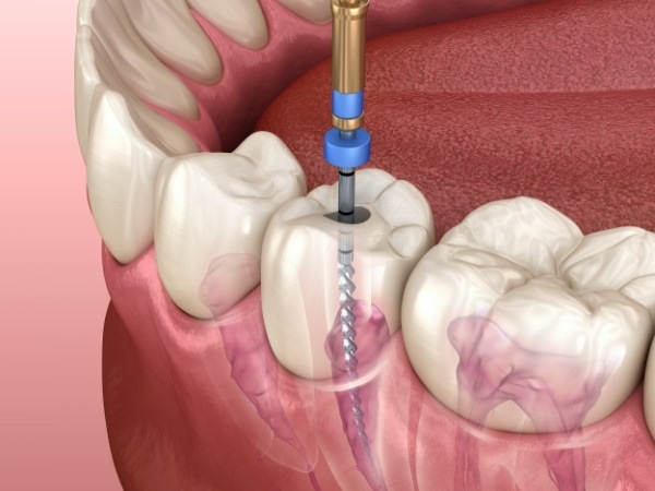 Animated smile during root canal treatment