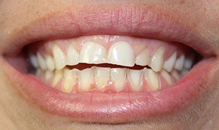 Closeup Abby's teeth with acid erosion and dental wear