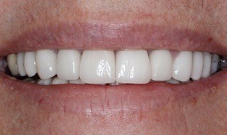 Closeup of dental patient's smile after dental restoration
