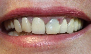 Closeup of dental patient's smile with uneven and discolored smiles