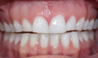Closeup of worn smile before cosmetic dentistry