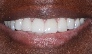 Closeup of flawless smile after tooth replacement