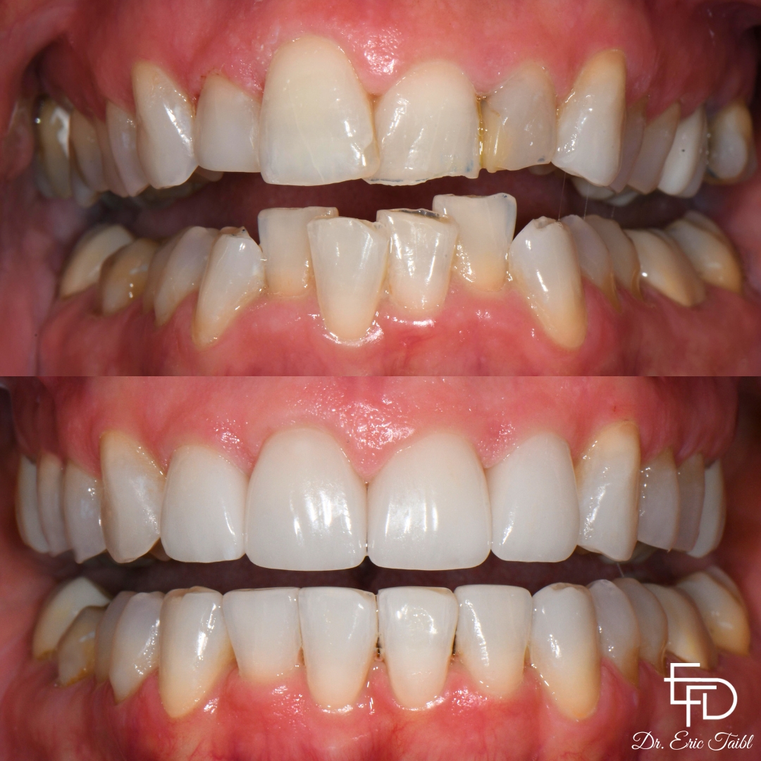 Smile before and after straightening crooked teeth
