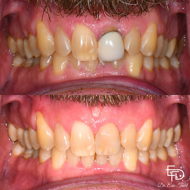 Smile before and after correcting flawed teeth
