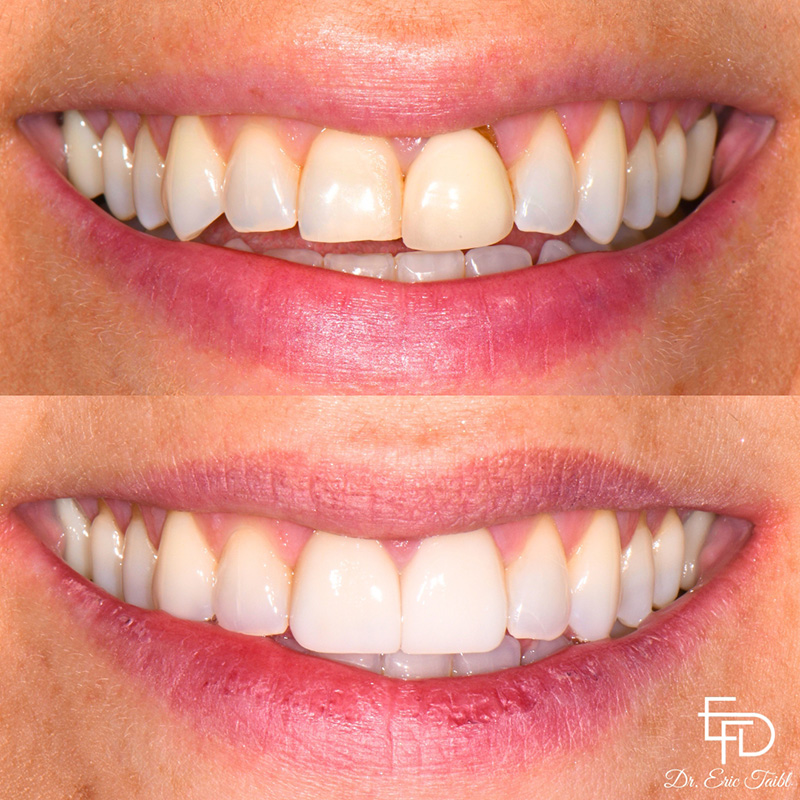 Smile before and after correcting flawed teeth