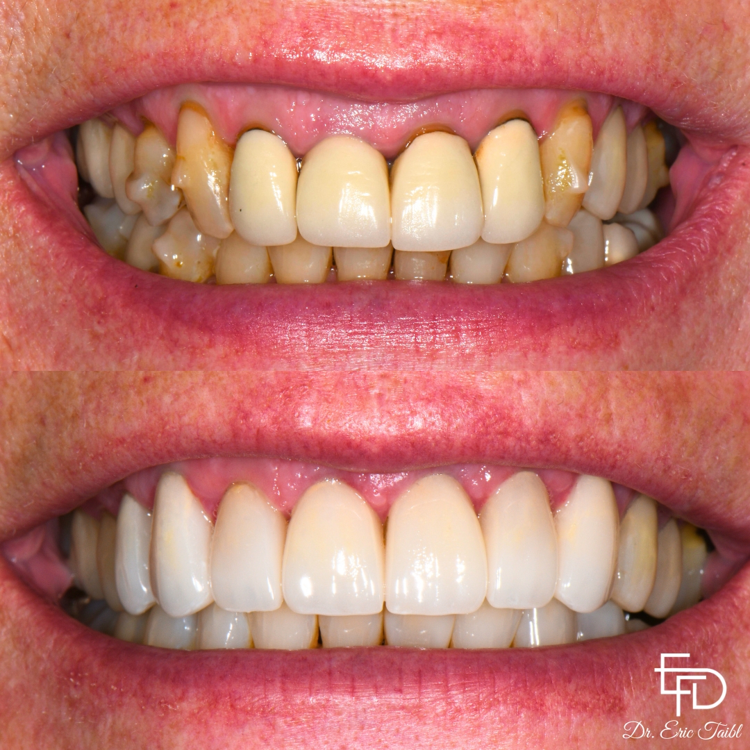 Smile before and after correcting flawed teeth