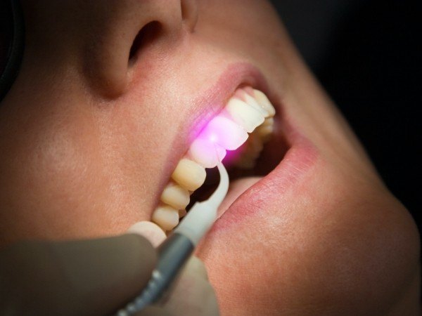 Dental patient receiving soft tissue laser dentistry treatment