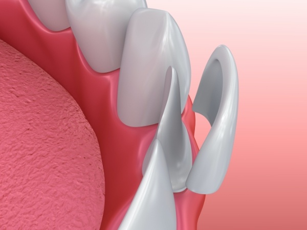 Animated smile during veneers placement