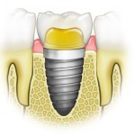 implant