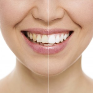 Brookfield teeth whitening