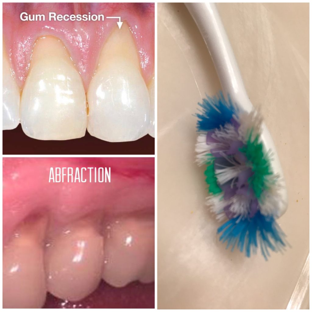 Why brushing hard isn't a good thing Elmbrook Family Dental