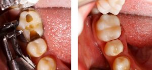 A damaged tooth compared to a restored tooth.