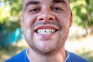 man with chipped tooth